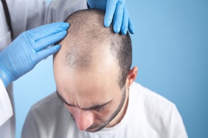 بهترین مرکز کاشت مو در اندیشه